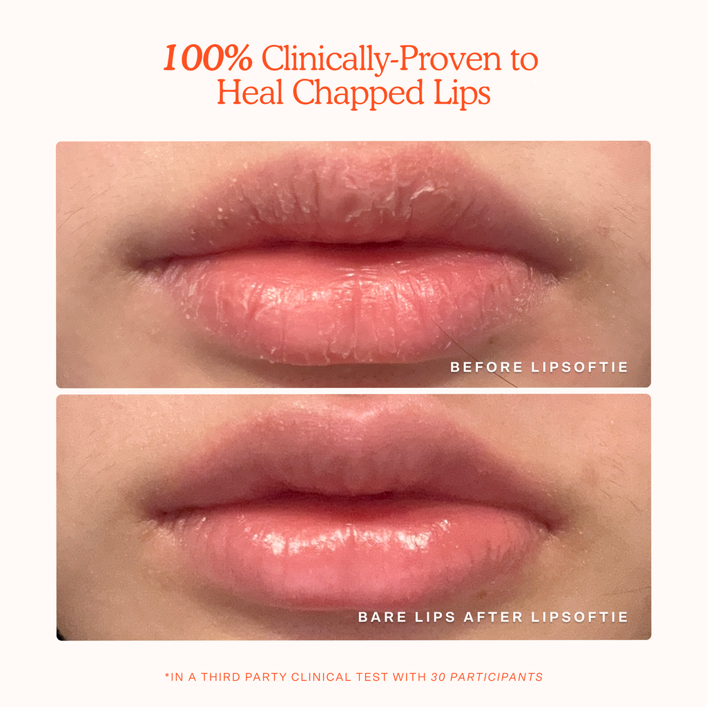 LipSoftie® Lip Treatment R2