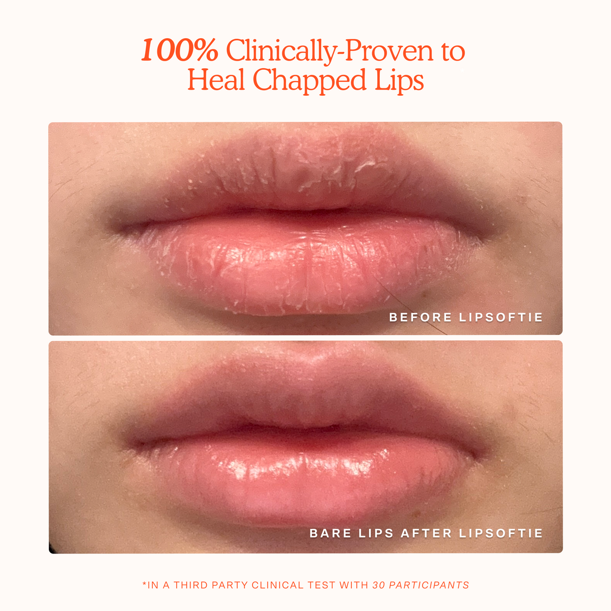 LipSoftie® Lip Treatment R2