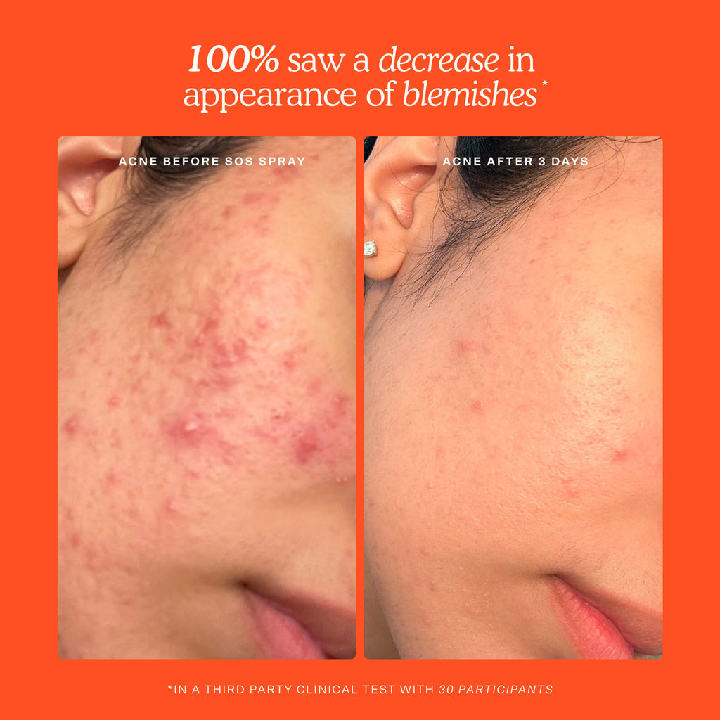 SOS 3-Step Skincare Set L6