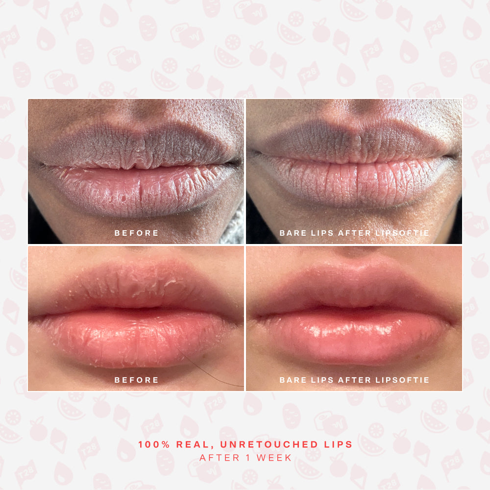 SOS LipSoftie® Lip Treatment Y5