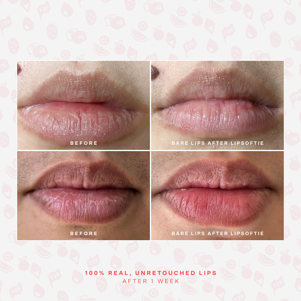 SOS LipSoftie® Lip Treatment Y5