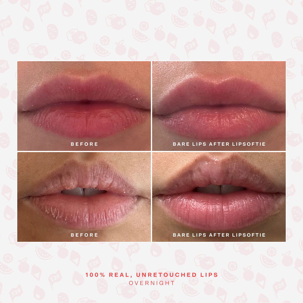 SOS LipSoftie® Lip Treatment M4